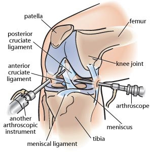 Knee Arthroscopy Procedure and Recovery