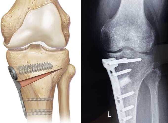 High Tibial Osteotomy FAQs by Dr. Jigar Desai