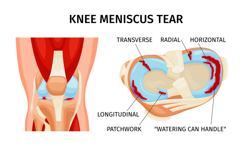 Meniscus Injury Consultation