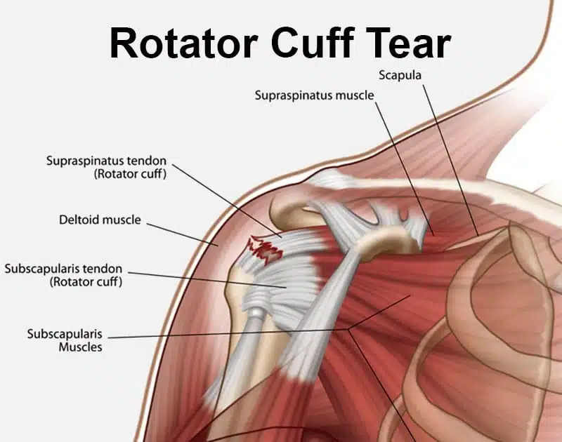 Rotator Cuff Tear Treatment