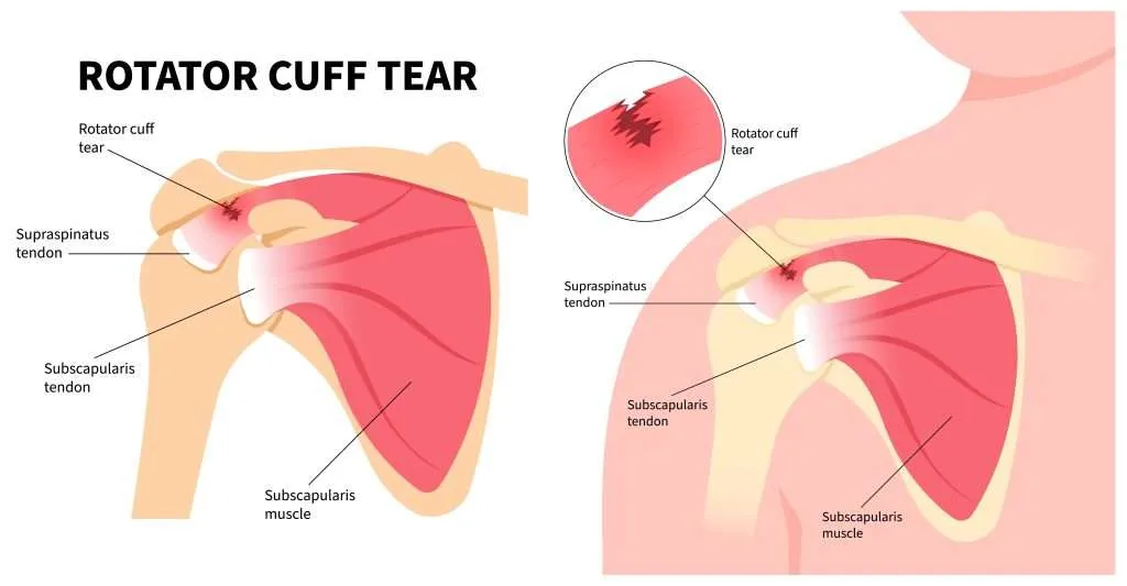 Shoulder Pain Treatment by Dr. Jigar Desai