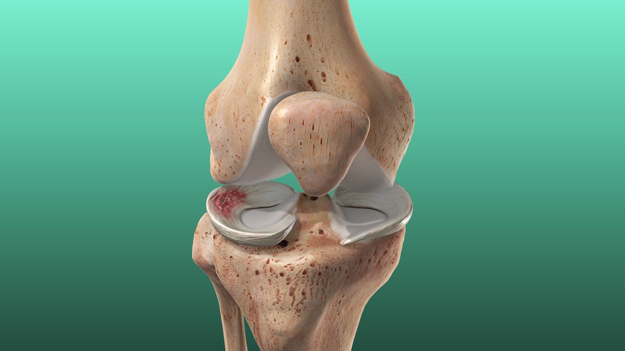 Meniscus Injury